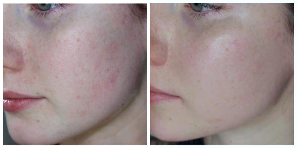 Red Light Therapy Acne Before And After